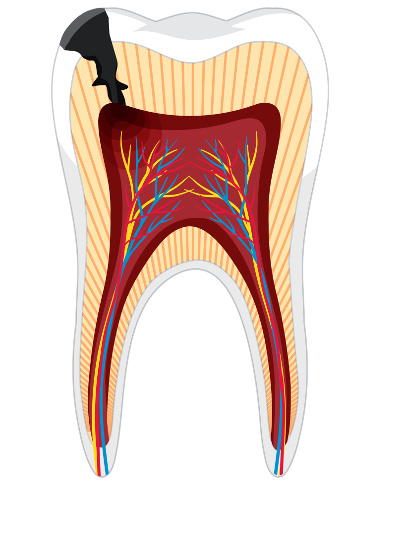 Fogbélgyulladás fogfájás esetén