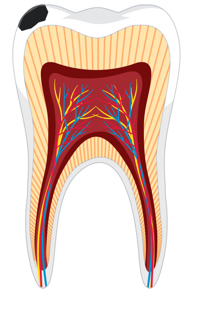 Fogfájás - fogszuvasodás esetén Fogfájás - fogszuvasodás